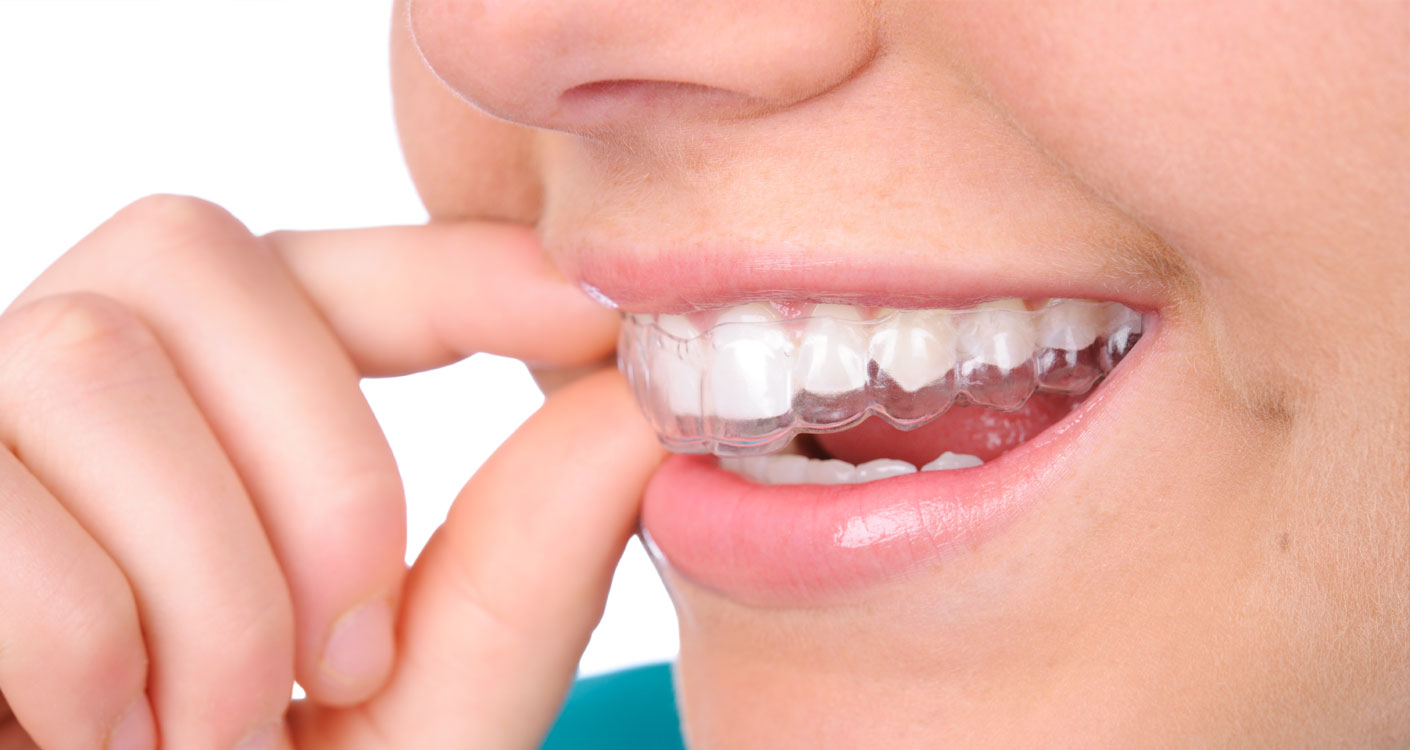 Zahnärzte Dr. Wunderer & Dr. Jung - Aligner-Therapie – durchsichtige Kunststoffschienen zur Korrektur von Zahnstellungen 1